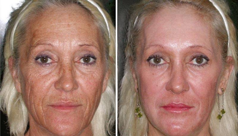 Peeling chimico esfoliante per rinnovamento cutaneo